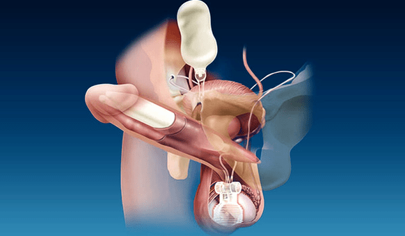 硅胶和凝胶厚度填充剂